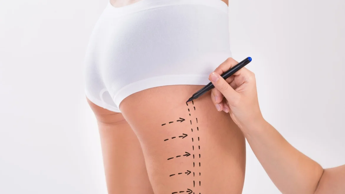 Thigh Lift in Turkey