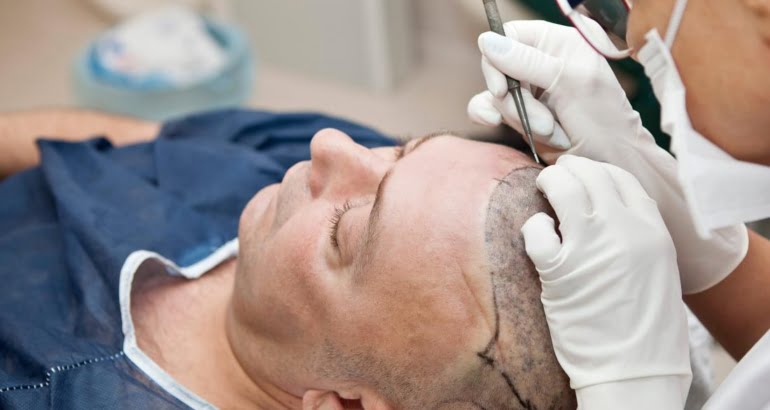 Hair Transplant in Turkey