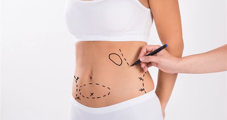 Liposuction in Turkey