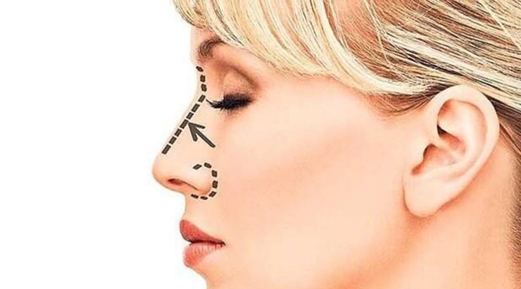 Rhinoplasty in Turkey