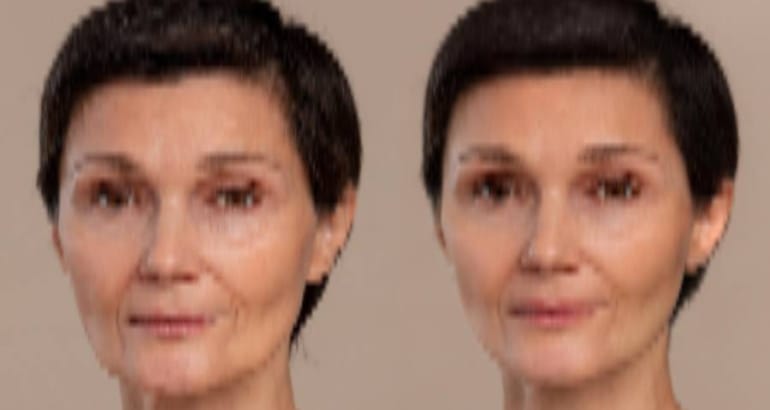 10 Signs You’re Ready for a Face Lift