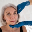 Why Deep Plane Facelift Ages Better Than Traditional Techniques